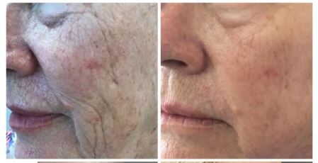 Microneedling