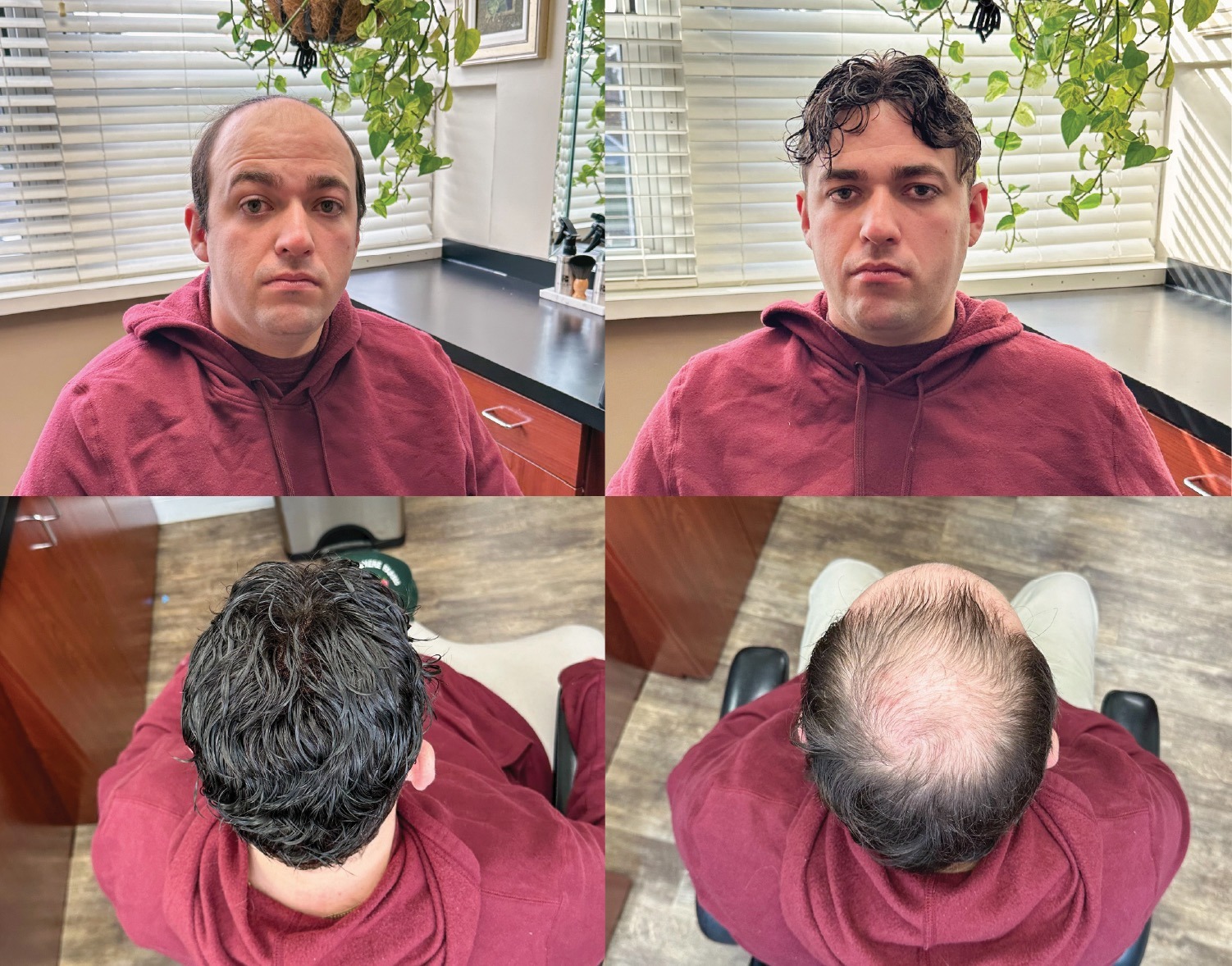 Riviera Hair Replacement blends 50 years of expertise with cutting-edge custom solutions for hair loss, offering a compelling alternative to surgical transplants.
